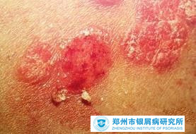 如何治疗牛皮癣好