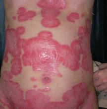 牛皮癣的治疗方法有哪些