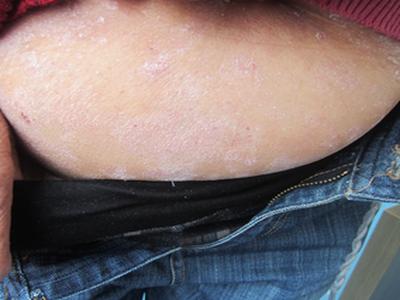 要如何治疗才能降低牛皮癣的危害