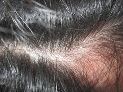 马齿苋治牛皮癣怎样用